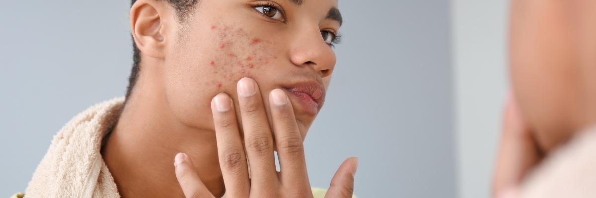 Como prevenir e tratar a acne na adolescência e pré-adolescência